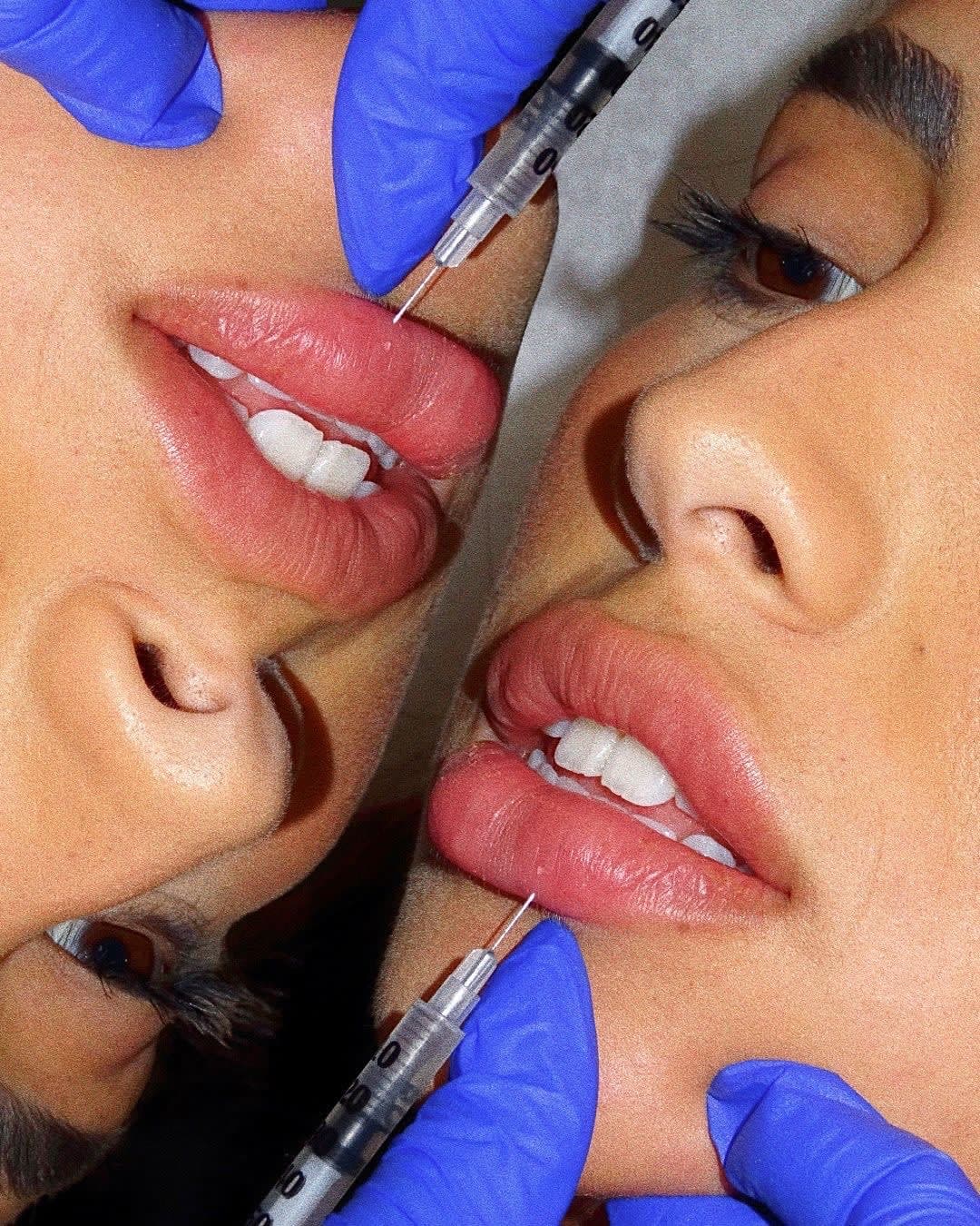 Lip Filler Cost: What You're Actually Paying For