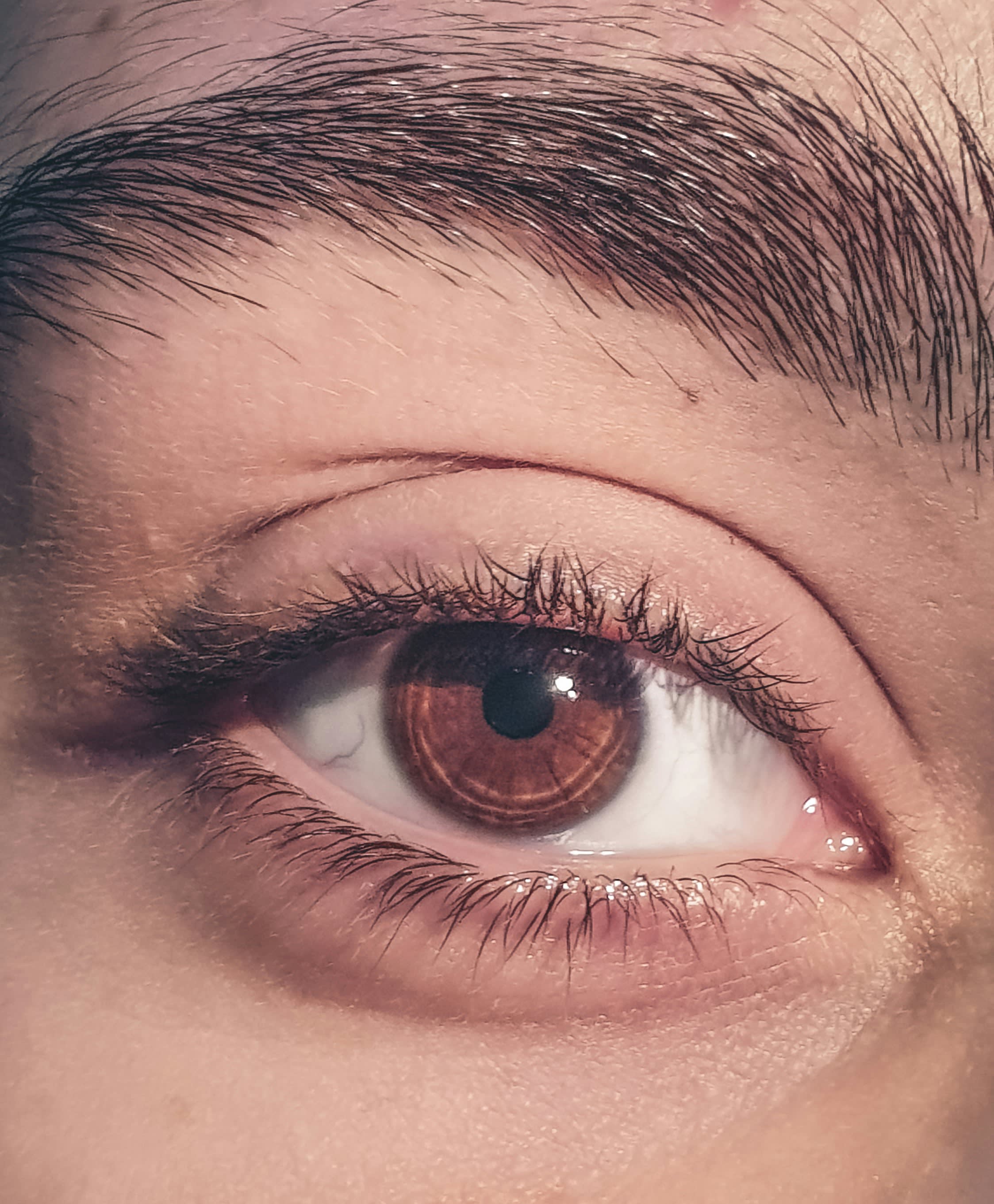 Eyebrow Laser Hair Removal: Shaping vs. Full Removal