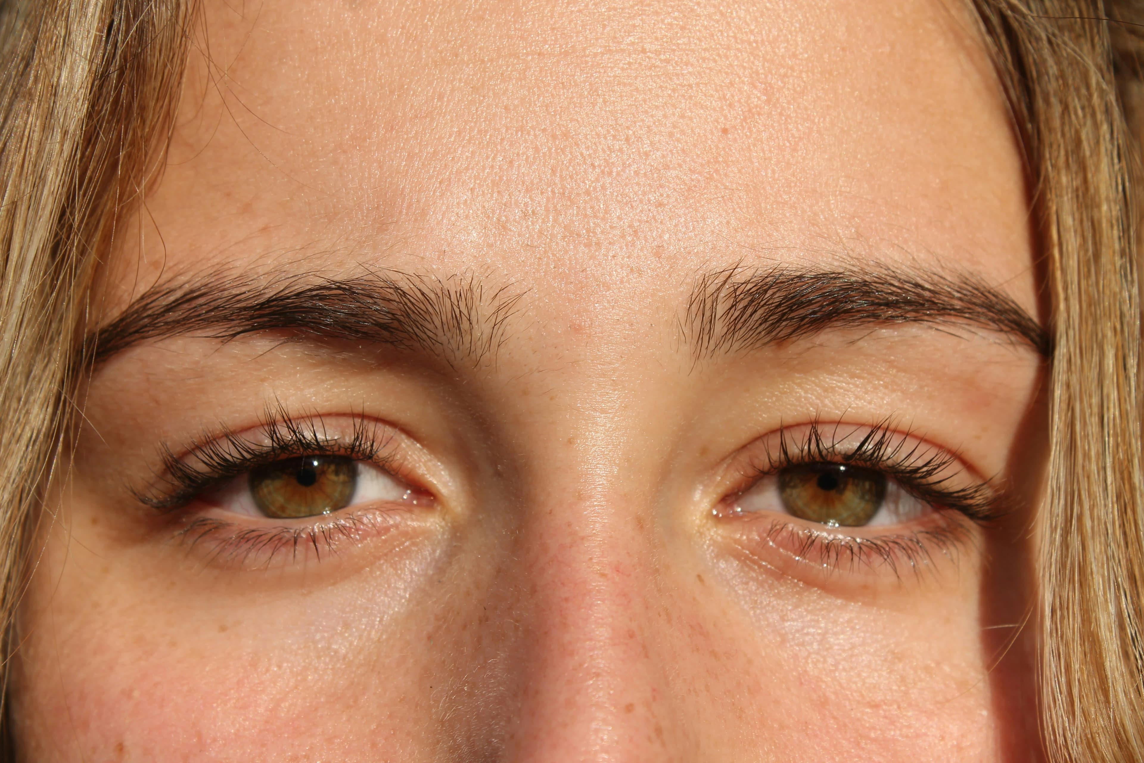 Laser for Unibrow and Stray Brow Hairs